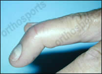 Hand Problems - Mallet Finger 